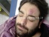 POZZUOLI/ Protesta per stipendio, aggredito dipendente mensa ospedale “La Schiana” – LE FOTO