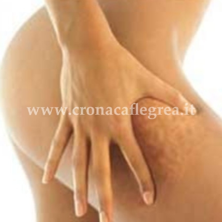 Cellulite: caratteristiche e rimedi