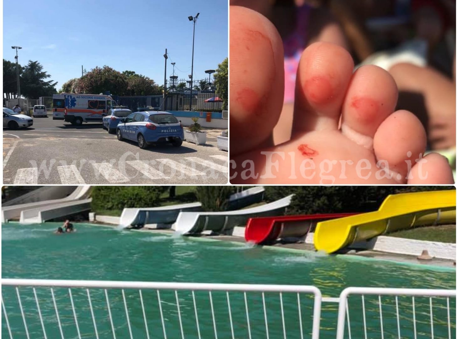«Bambini con bolle e bruciature al “Pareo Park” di Licola» arrivano ambulanze e polizia – LE FOTO