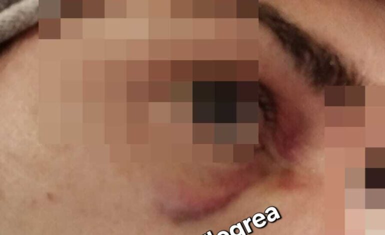 POZZUOLI/ Sequestrata e picchiata dalla ex e dalle amiche, l’incubo di Anna «Io vittima di un agguato»
