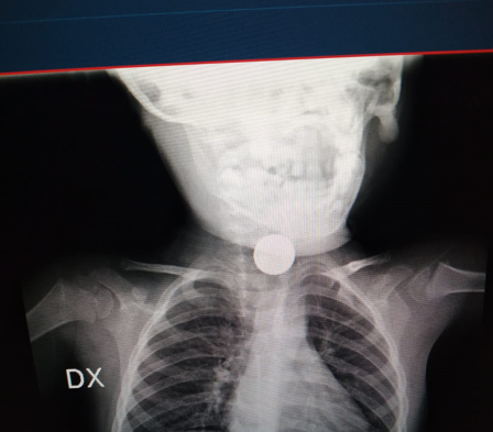 Ingoia pila a disco, bimbo di due anni operato d’urgenza al Santobono