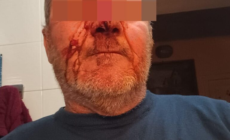 Picchiato da baby gang a Monte di Procida, 56enne in ospedale col naso rotto