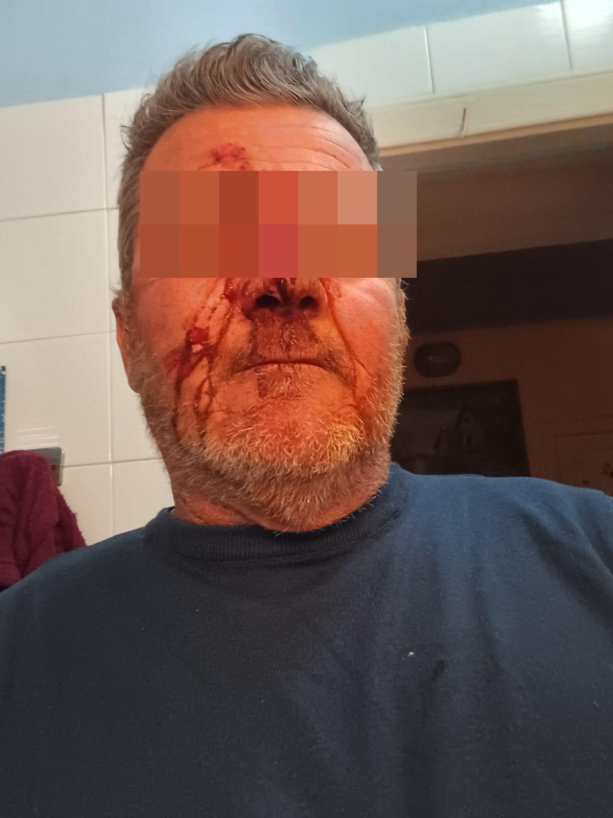 Picchiato da baby gang a Monte di Procida, 56enne in ospedale col naso rotto