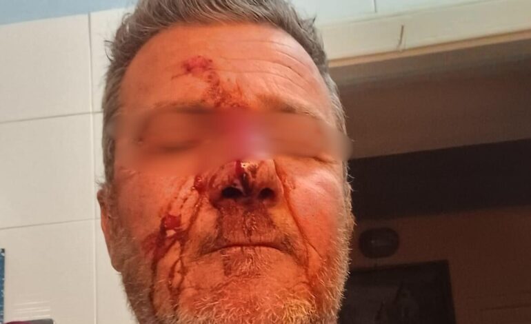 Giallo sull’aggressione di Monte di Procida: i dubbi sul racconto della vittima “discriminata” dal sindaco Santolillo