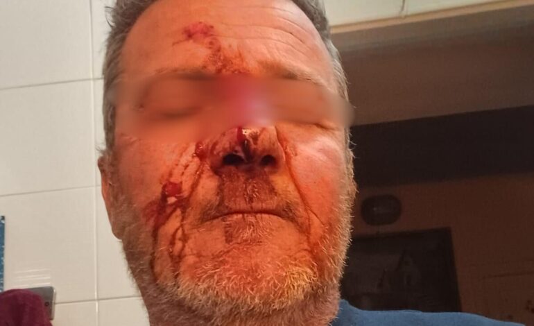 Aggressione a Monte di Procida, parla la vittima «C’erano anche dei giovani. Mi dispiace non essere creduto»