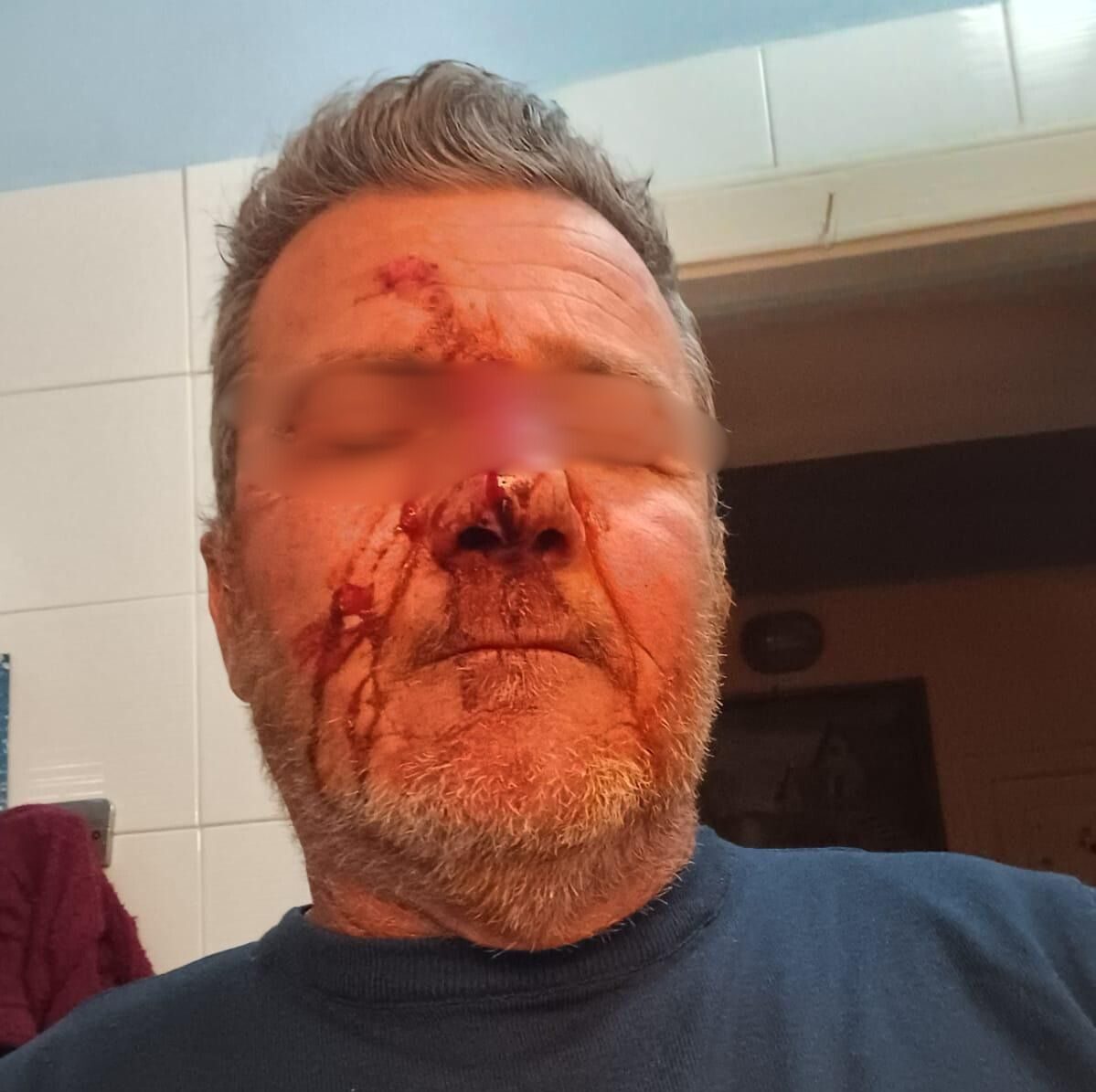 Aggressione a Monte di Procida, parla la vittima «C’erano anche dei giovani. Mi dispiace non essere creduto»