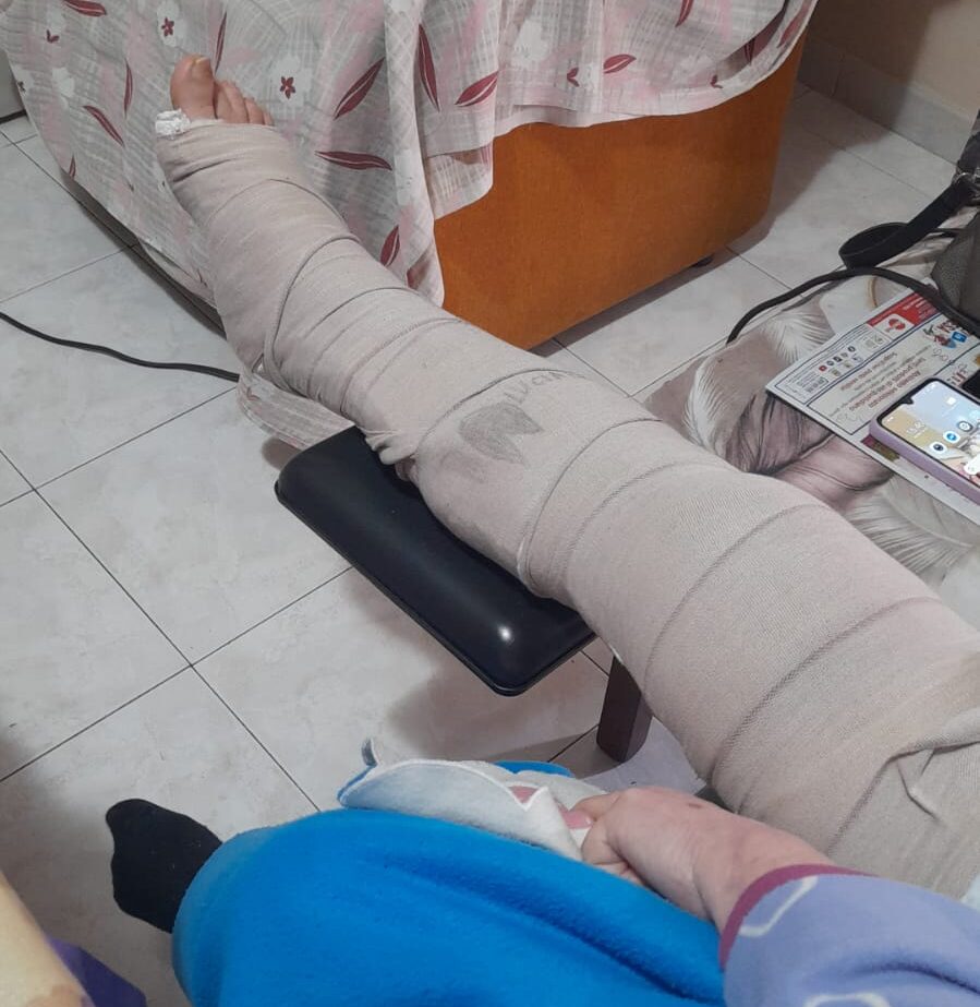 Anziana operata all’ospedale di Pozzuoli, ma il gesso non le viene tolto «Dovevano farlo entro 30 giorni»