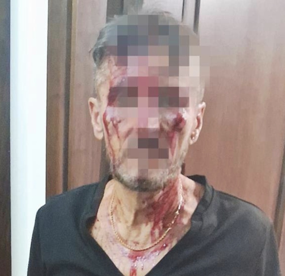 Choc a Bacoli, 60enne aggredito con una mazza di ferro dal nipote